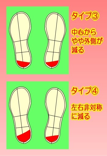 靴底の減り方 5タイプ